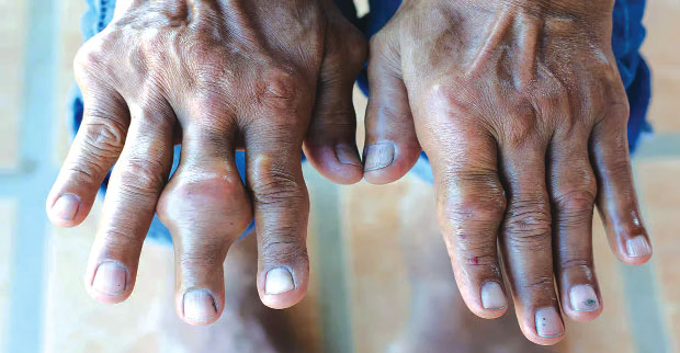 Arthrite au Bénin : ces douleurs silencieuses qui paralysent le quotidien